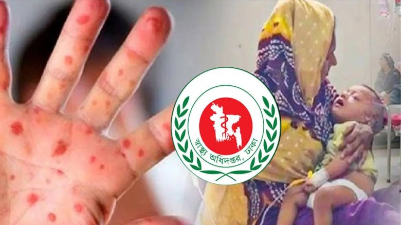 হামের উপসর্গে আরও ৪ শিশুর মৃত্যু, নতুন শনাক্ত ১১৬